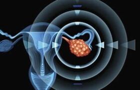 امیدی برای درمان سرطان تخمدان با استفاده از رفتار سلول‌هایی که متاستاز می‌دهند
